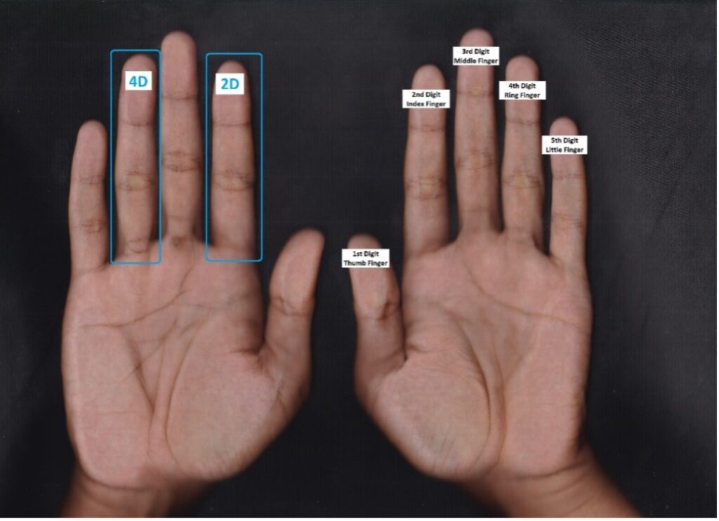 An example of low digit ratio (ring finger is longer than index finger)