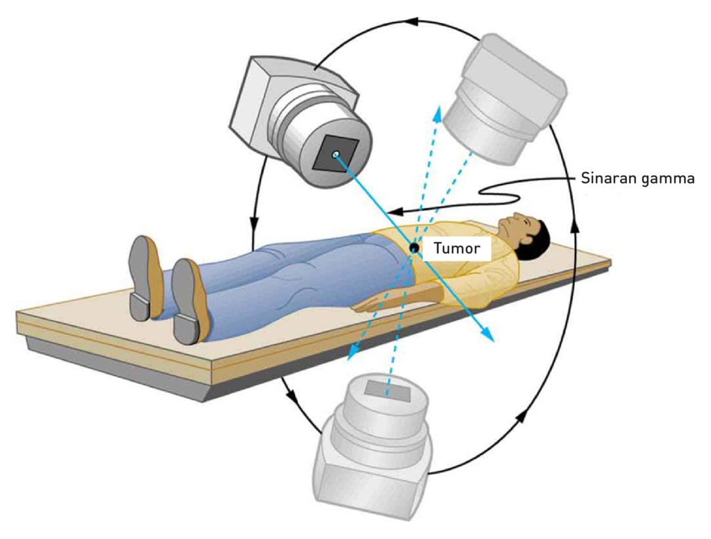 Kaedah radioterapi dengan sinaran mengion untuk merawat kanser.