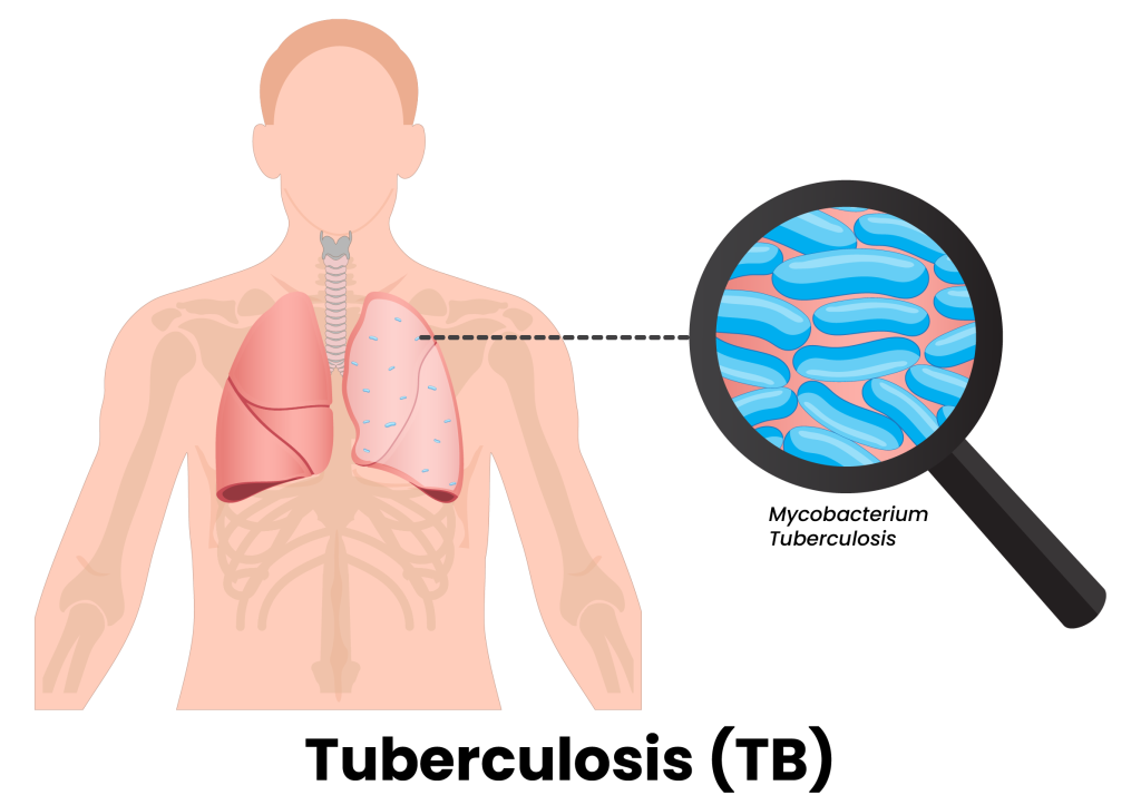 tuberculosis, TB