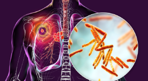 tuberculosis, TB, public health, environment, transmission