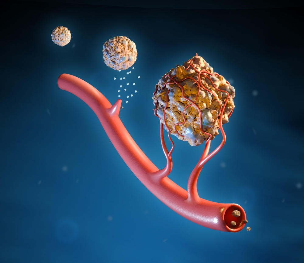 kanser, angiogenesis